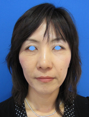 目の下のたるみ、目のくまでお悩みの方、切らずに完璧に解決します。TCB-R法　手術直後　症例写真